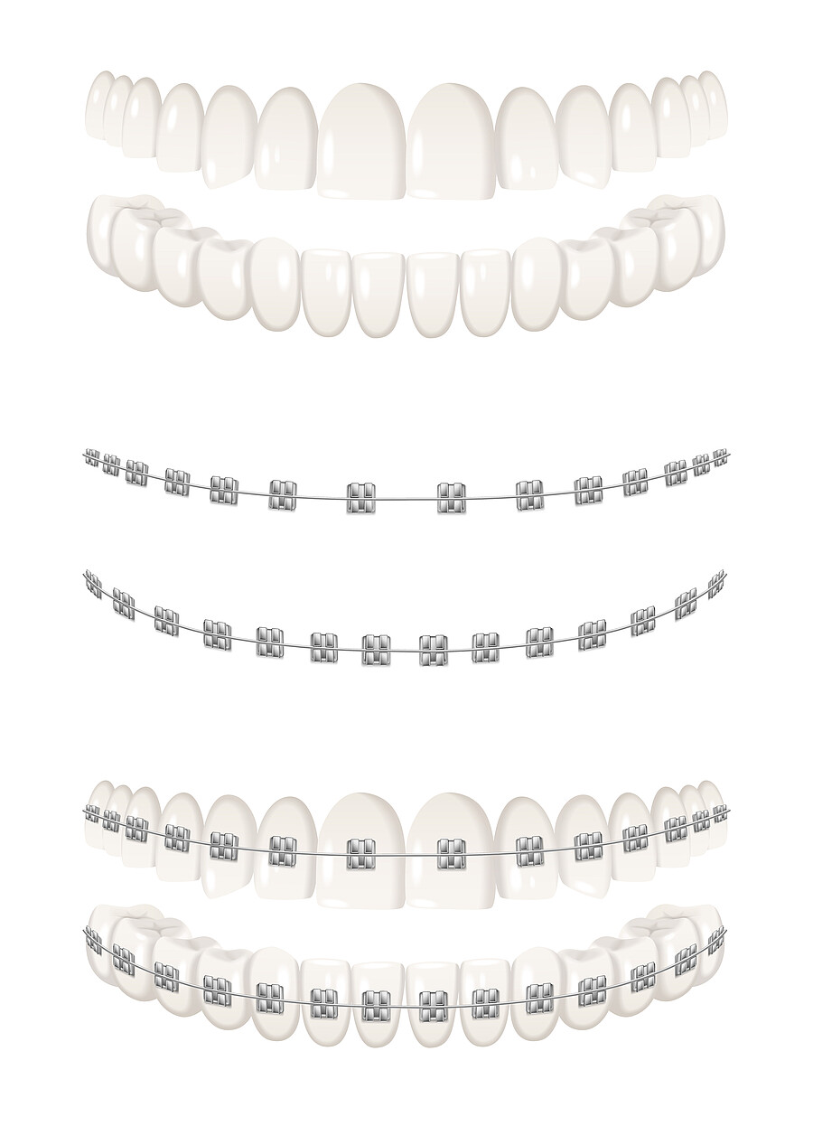 Teeth dental braces realistic icons set isolated vector illustration