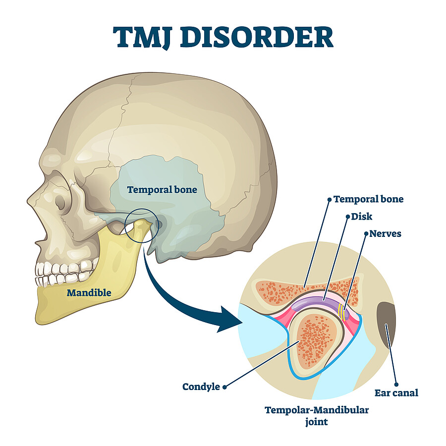 TMJ, disorder, temporomandibular, joint, condition, jaw, illness, educational, anatomical, explanation, head, structure, health, medical, pain, dysfunction, muscles, mastication, mandible, skull, movement, clicking, TMJD, chronic, symptomatic, temporal, bone, disk, nerves, condyle, mandibular, ear, canal, closeup, isolated, anatomy, body, internal, human, organ, biology, info, parts, graphic, model, infographic, labeled, handout, syndrome, oral