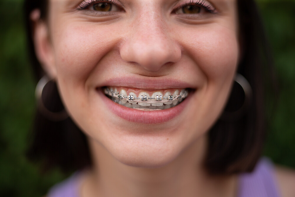 female, dental, white, face, smile, braces, portrait, girl, happy, young, orthodontics, healthy, mouth, lips, health, macro, tooth, transparent, pure, isolated, dentistry, woman, care, adult, person, closeup, brackets, dentist, equipment, metal